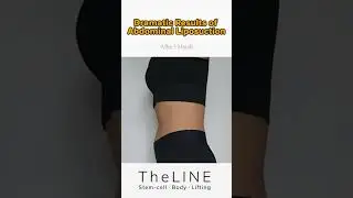 Dramatic Results of Abdominal Liposuction #kbeauty #abdominallipo #abdominalliposuction