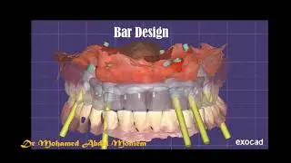 Digital Denture conversion (additive workflow )