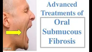 TREATMENT STRATEGIES FOR OSMF #ORALSUBMUCOUSFIBROSIS #HOWTOTREAT #DENTALLECTURES #MEDICINE #PHARMA