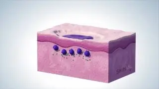 SKINIAL tattoo removal method - SKIN-DO-MA