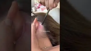 Cicatriz do lifting facial: ser&aacute; que fica aparente? Dra Bruna Jacobowski Cirurgi&atilde; Pl&aacute;stica Joinville