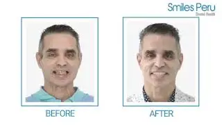 Smiles Peru : Video Testimonial Full Mouth Dental Implants and Porcelain Crowns