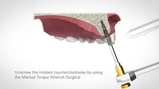 Implant Retrieval Instrumentation