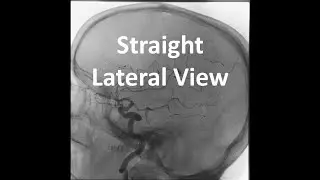 Straight Lateral Neuro-Angiographic View: What is it? Why is it used? How to set it?