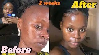 How I cleared my skin using 2 Supplements | My acne journey😒