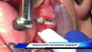 How to add a tooth on the existing partial denture