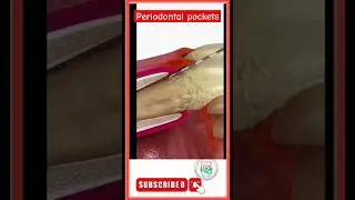 Periodontal pockets depth #foryou #advancedentistry #fypyoutube #viral2025 #moderndentistry