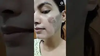 TCA Peel Remove 5th Day ||Chemical peel remove