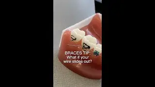 Брекеты торчат из щёк или дёсен? Что делать... 🦷 #шорты