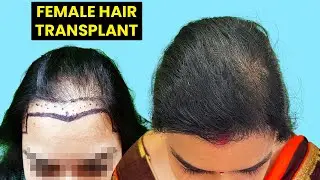 Best Female Hair Transplant In India | Female Hair Transplant Before & After |