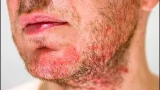 Ways you can prevent aftershave rash! You may want to know this