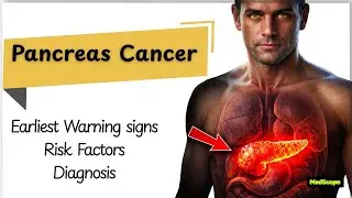 What are the WARNING Signs of Pancreatic Cancer?