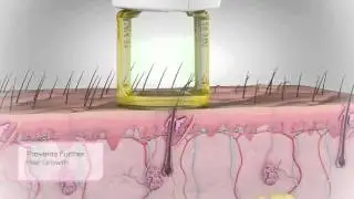 Gentle Hair Removal