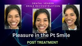 Dental Veneers  Smile Design case