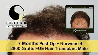 2800 Grafts Adult Male Norwood 4 FUE