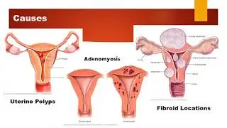 Abnormal Uterine Bleeding AUB
