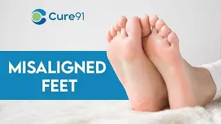 Everything You Need to Know about Misaligned Feet | Cure 91