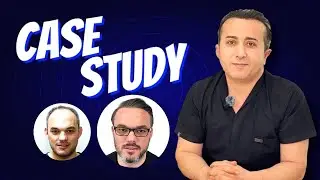 Dr. Resul Yaman Evaluates a 7 Year Hair Transplant Result: Before and After Comparison