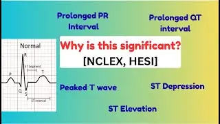 ECG Interpretation Made Easy