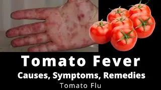 Tomato fever | Tomato Flu | Tomato Fever Causes Symptoms Treatment | Tamil | Success Buds