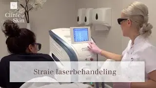 Striae laserbehandeling