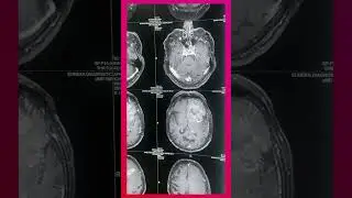 Large brain tumor surgery in 86 year old male successful [ Radiology ]