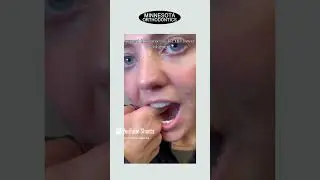 How to take out Invisalign Aligners!