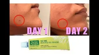 TESTING TEA TREE ACNE GEL: HOW MANY DAYS TO GET RID OF A ZIT