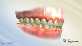 Why Oral Hygiene Matters with Braces | Gingivitis & White Spots