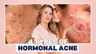 Acne Specialist Reveals 4 Hormonal Acne Types and How to Fix Them