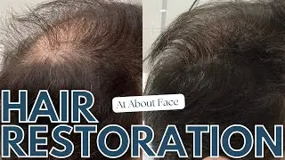 Revolutionizing Hair Restoration: ALMA TED Technology & PRP at About Face