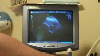 Ultrasound 29-Jul-2009