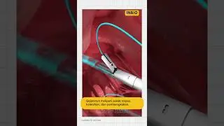 Proses operasi katup jantung