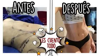 ME OPERÉ EL ABDOMEN (LIPOMARCACIÓN) *¿Duele mucho?* // NattyCastro