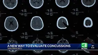 UCSF doctors develop new concussion testing method