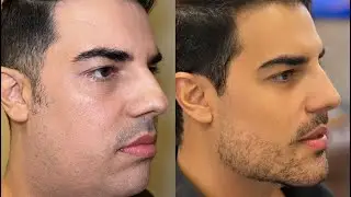😱Transforma&ccedil;&otilde;es de Cair o Queixo! Lipo de Papada com Dra Lorena Linhares &mdash; INSCREVA-SE!&rdquo;