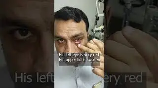 ashoob e chasm (adenoviral infection) say kaysy nimta jay