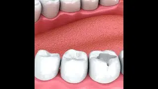 Prosthodontics - Restorative Dentistry at Audley
