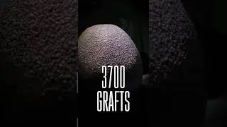 HAIR TRANSPLANT WITH 3700 GRAFTS - SMILE HAIR CLINIC #hairtransplantturkey