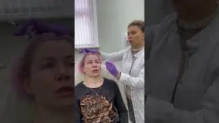 Контурная пластика височной зоны препаратом BioHyalux Deep Dermis