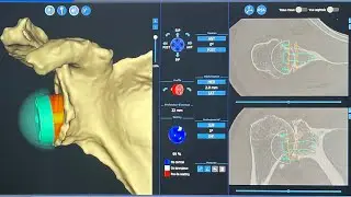 Planification pr&eacute;op&eacute;ratoire d&rsquo;une Proth&egrave;se totale d&rsquo;&eacute;paule invers&eacute;e + BIO-RSA