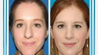 Testimonio Rinoplastia Ultrasonica | Aurea Clinic Sevilla | Dra. Martínez Padilla