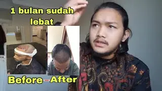 TANAM RAMBUT TRANSPLANTASI DI TURKI