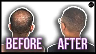 This is How I Conceal My Thinning Hair