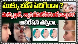 ముక్కు బోన్ పెరిగిందా ? ఆపరేషన్ తప్పదా | Nose Growth Problem | Nose Operation | @CVRHealth