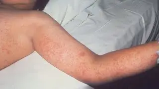 South Carolina school districts share plans as measles outbreak continues