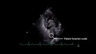 Stroke From Paradoxical Embolism Through a Patent Foramen Ovale