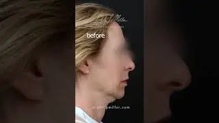 Deep Plane Facelift And Fat Transfer At NYC! Incredible Transformation!