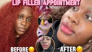 LIP FILLER VLOG ON BLACK GIRL/WOMAN 🫦💉 + RAW & UNCUT (FULL EXPERIENCE)