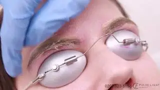 Laser Eyebrow Tattoo Removal Procedure Treatment with PicoWay Pulse Light Clinic
